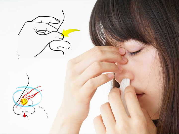 Носовое кровотечение - причины, симптомы, диагностика и лечение