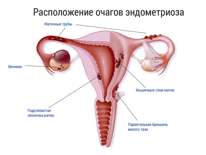 Что такое эндометриоз матки
